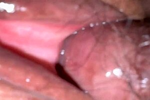 Amateur pink area 170 days after first time.